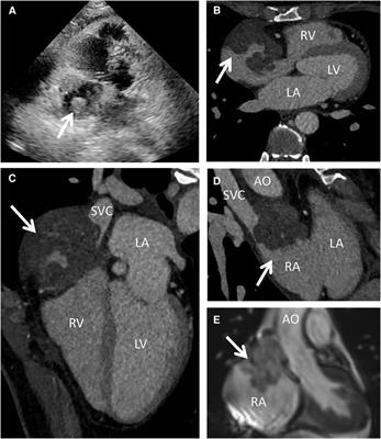 Case Report: Successful surgical management of a challenging primary cardiac angiosarcoma